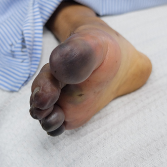 Davolanmagan qandli diabet — gangrena